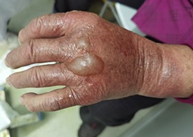 烫伤后是把伤口包扎还是暴露?