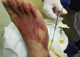 烧伤后能洗澡吗?